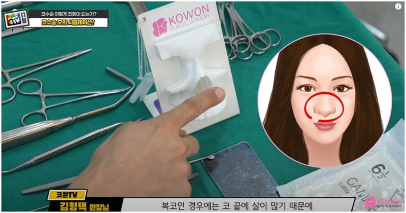코성형외과추천 받는 곳 코수술연골 이용하여 사진 10