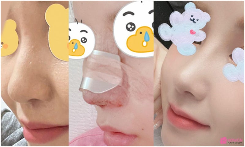 결혼전성형 많이 하는 곳 날렵한코 모양으로 사진 10