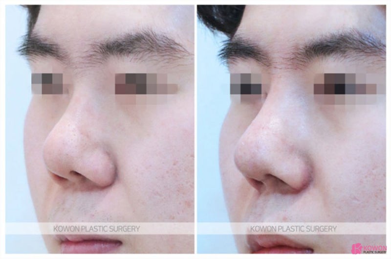 코재수술후기 공유 비순각성형외과 사진 4
