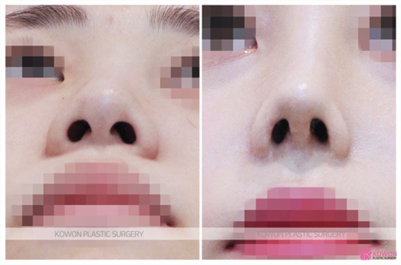 비중격연장술 진행 케이스 강남구청역성형외과 사진 6