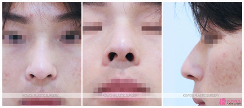 신사역성형외과 무보형물코수술후기 방법