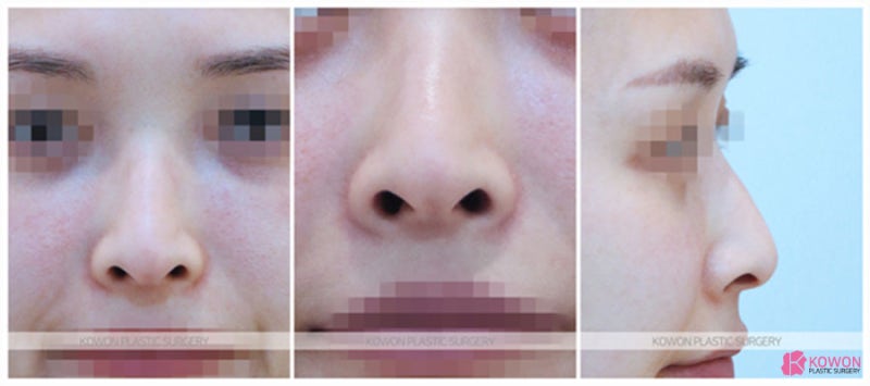 압구정코성형외과 용코수술 콤플렉스 해결 사진 3