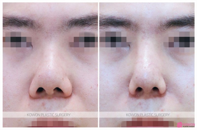 코잘하는성형외과 복코재수술 진행 사례 사진 6