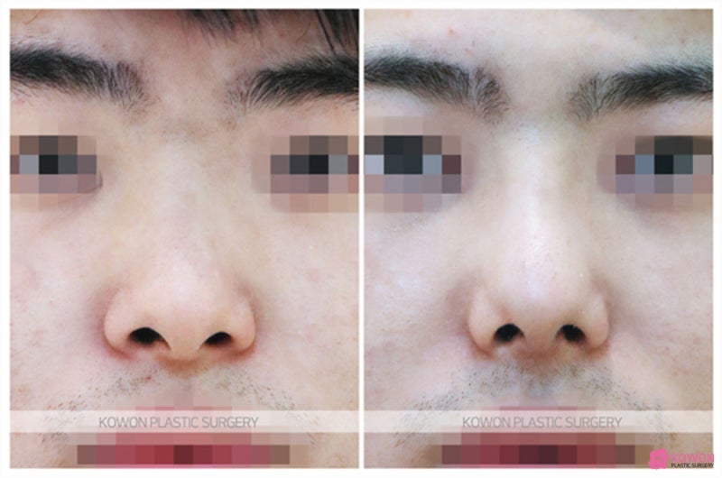 휜코비염 기능적인 문제 개선 학동역성형외과 사진 5