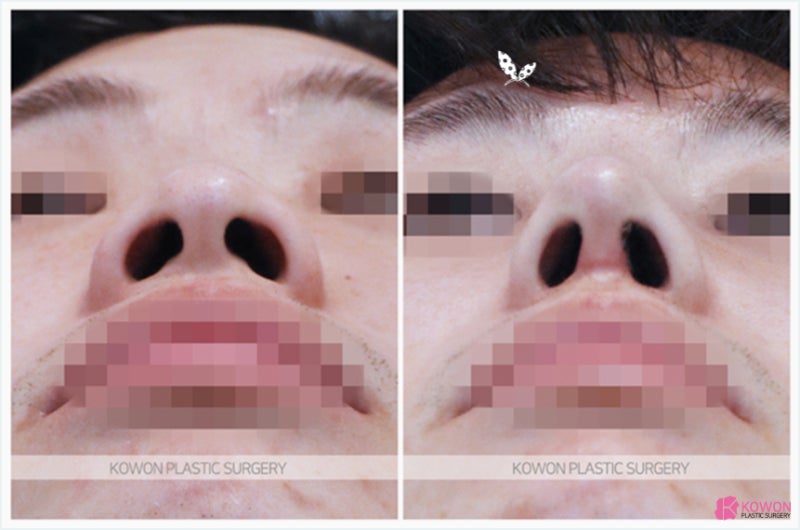 강남유명한성형외과 주먹코수술 계획 결과 사진 사진 3