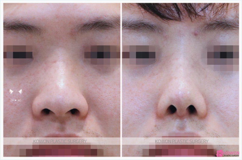 강남유명한성형외과 주먹코수술 계획 결과 사진 사진 6