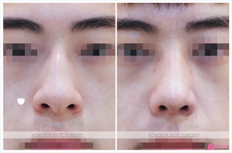 남자코성형잘하는곳 코매부리성형후기 차이 비교 케이스 사진 7