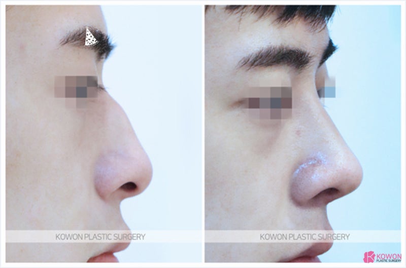 남자코성형잘하는곳 코매부리성형후기 차이 비교 케이스 사진 4