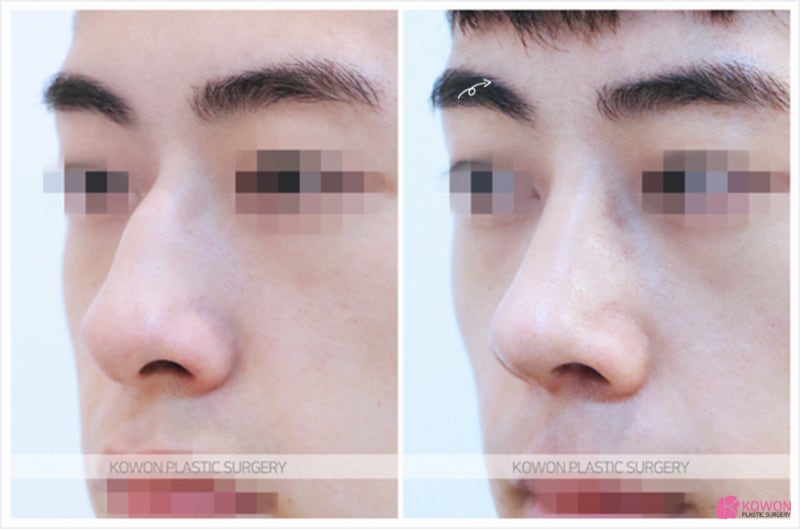 남자코성형잘하는곳 코매부리성형후기 차이 비교 케이스 사진 5