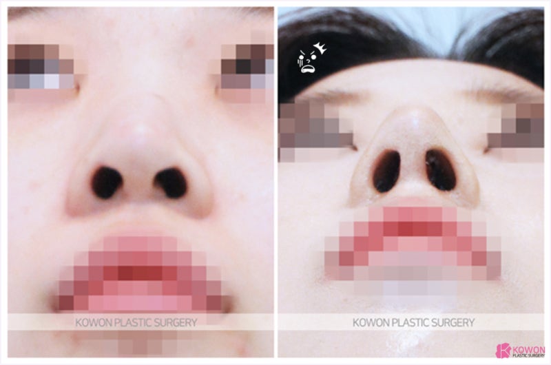 청담성형외과 긴코수술 전후사진 절제 이목구비 사진 4