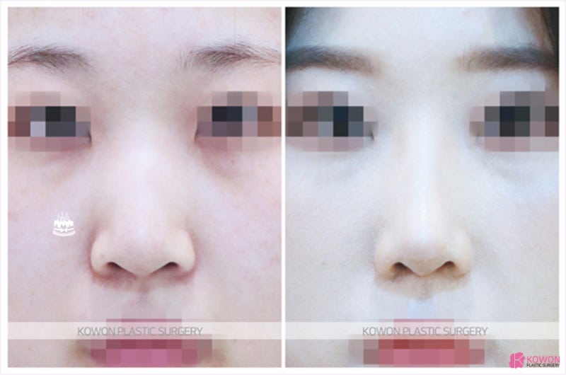 청담성형외과 긴코수술 전후사진 절제 이목구비 사진 5