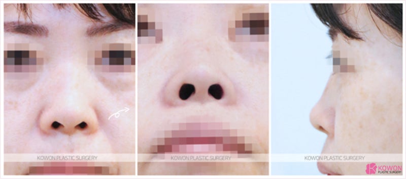 코성형외과추천 중년코수술 디자인 변화 느낌 형태 사진 2