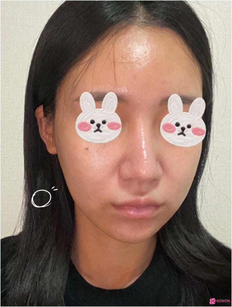 코재수술후기 화살코교정 알레르기 항생제 통증 사진 3