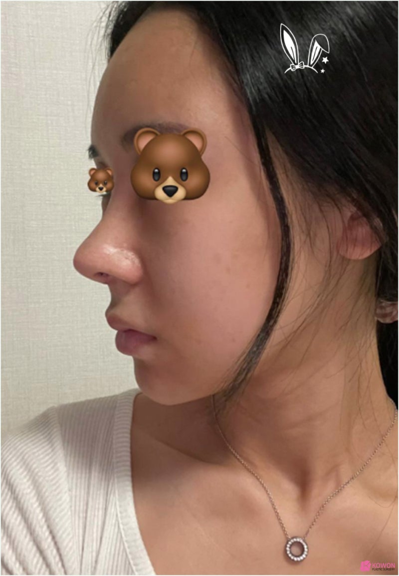 코재수술후기 화살코교정 알레르기 항생제 통증 사진 6
