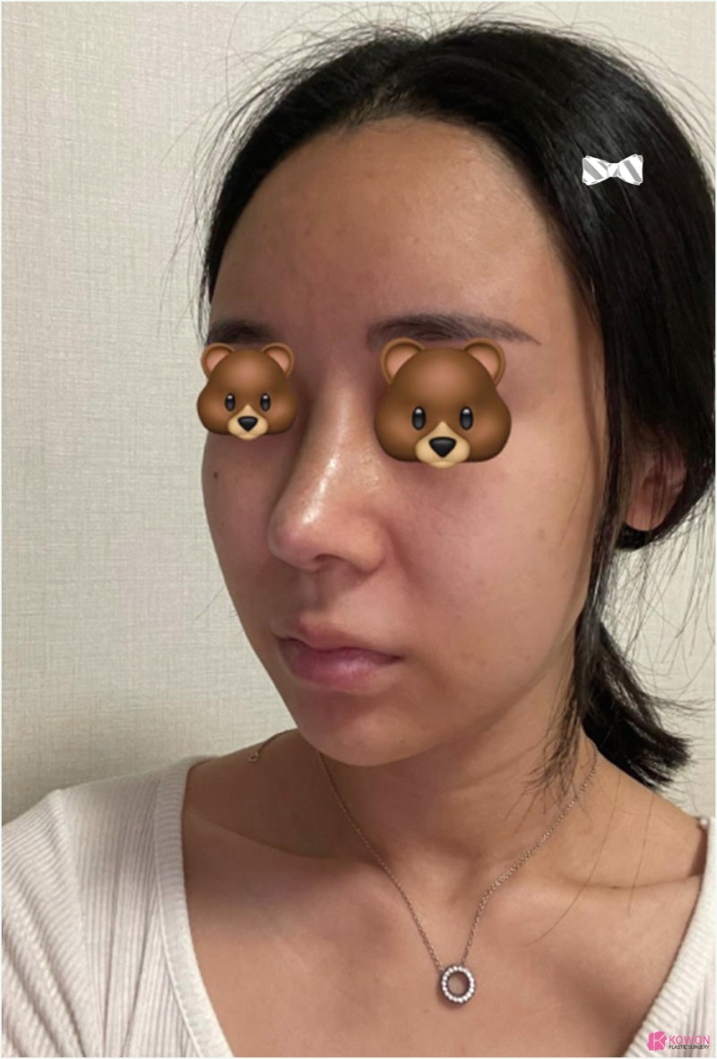 코재수술후기 화살코교정 알레르기 항생제 통증 사진 5