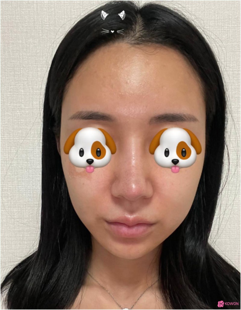 코재수술후기 화살코교정 알레르기 항생제 통증 사진 7