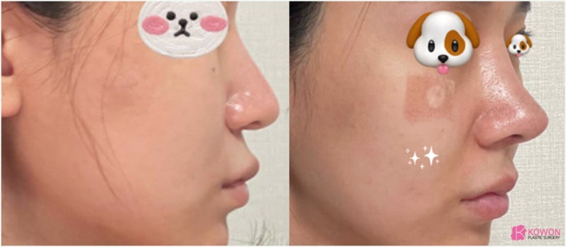 코재수술후기 화살코교정 알레르기 항생제 통증 사진 10