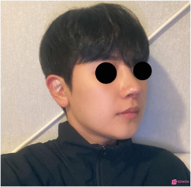 남자코재수술후기 콧구멍비대칭 맞춘 방법 사진 7
