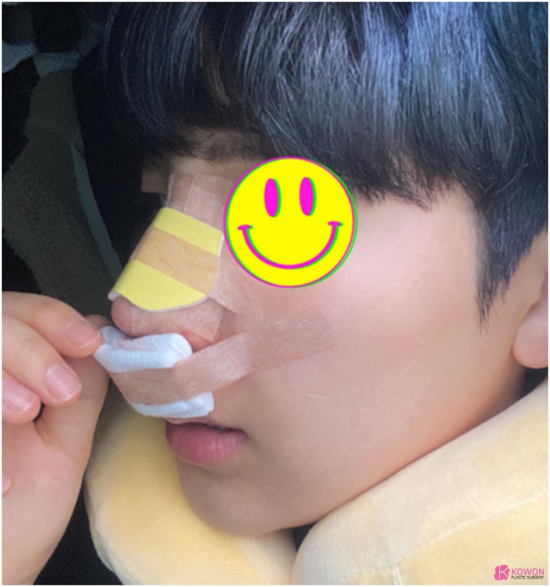 남자코재수술후기 콧구멍비대칭 맞춘 방법 사진 5