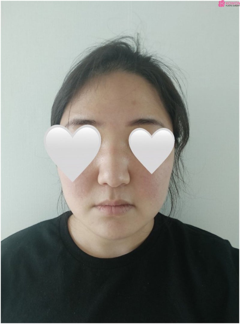 복코성형후기 이미지 차이 코끝높이기 한 달 변화 사진 4