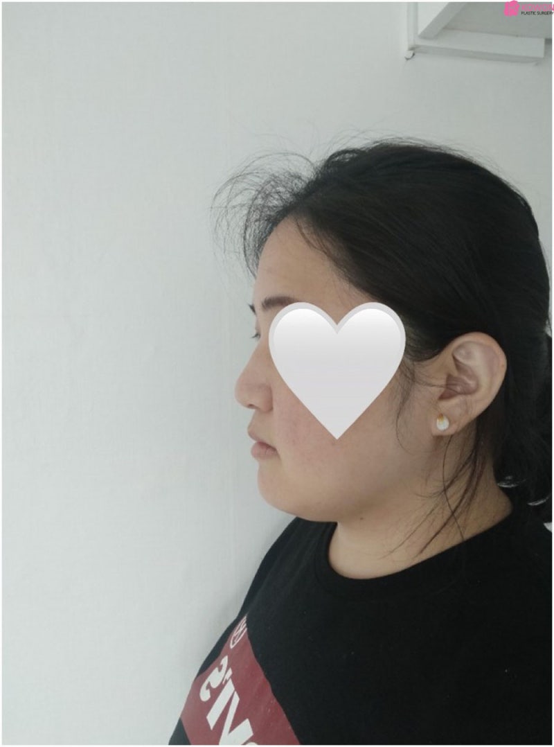 복코성형후기 이미지 차이 코끝높이기 한 달 변화 사진 3