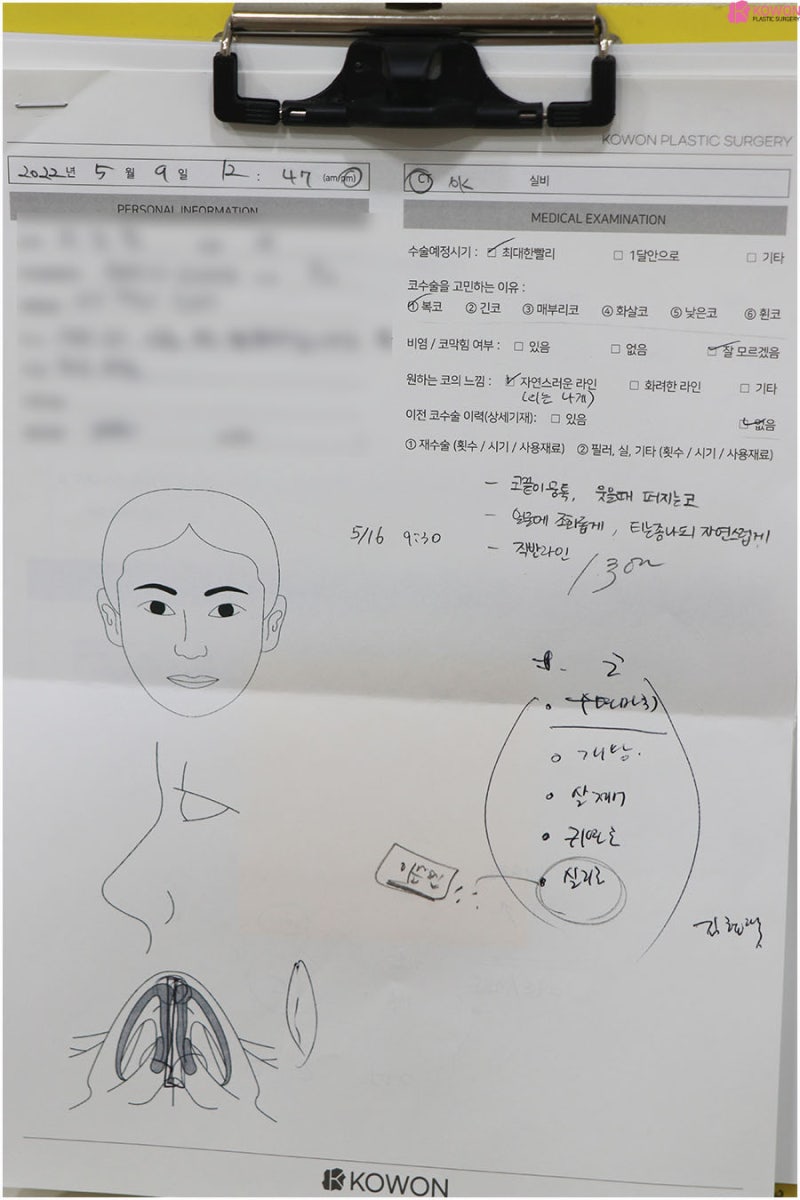 복코성형후기 이미지 차이 코끝높이기 한 달 변화