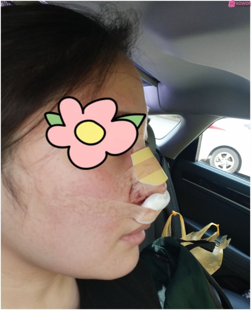 복코성형후기 이미지 차이 코끝높이기 한 달 변화 사진 5