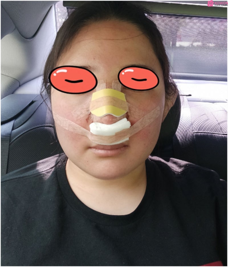 복코성형후기 이미지 차이 코끝높이기 한 달 변화 사진 6