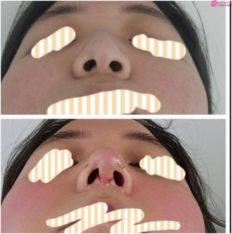 복코성형후기 이미지 차이 코끝높이기 한 달 변화 사진 12