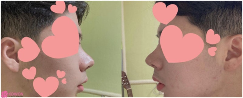 압구정로데오성형외과 두꺼운코 콤플렉스 해결 사진 6