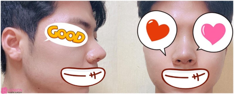 압구정로데오성형외과 두꺼운코 콤플렉스 해결 사진 5