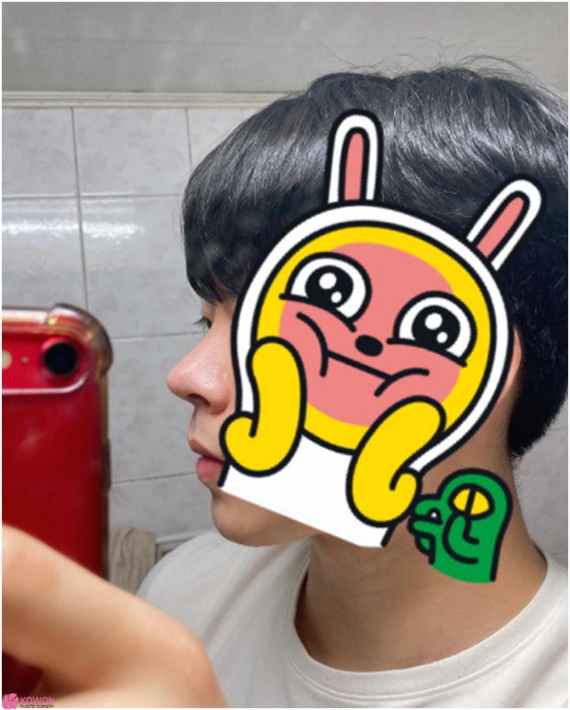 압구정로데오성형외과 두꺼운코 콤플렉스 해결 사진 8