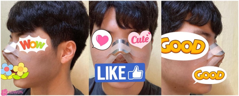 압구정로데오성형외과 두꺼운코 콤플렉스 해결 사진 4