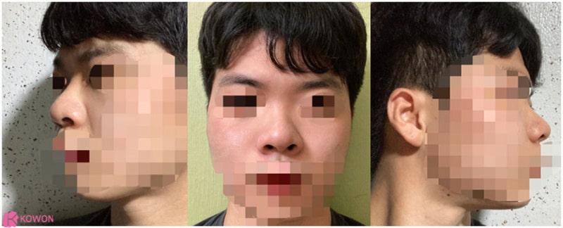 압구정로데오성형외과 두꺼운코 콤플렉스 해결