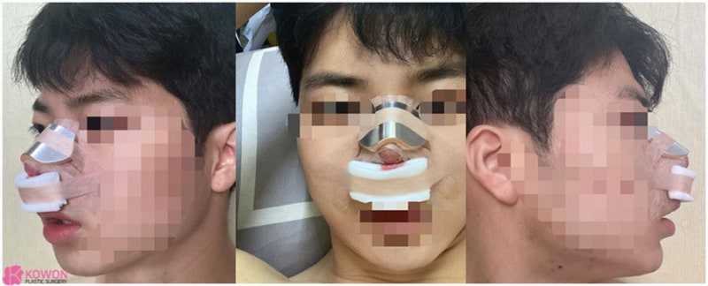 압구정로데오성형외과 두꺼운코 콤플렉스 해결 사진 3