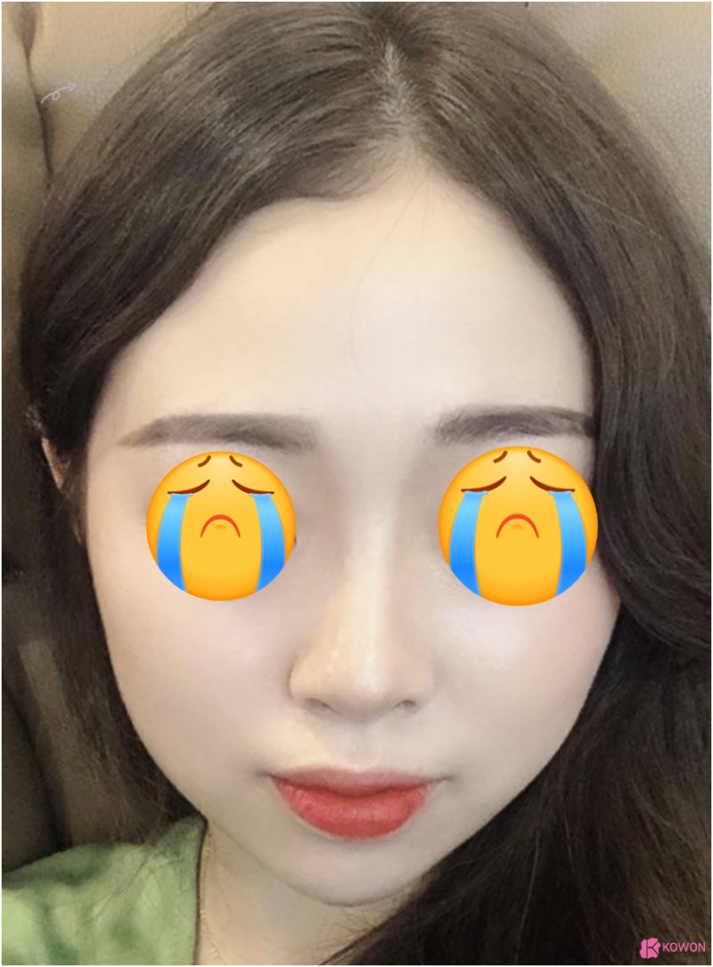 작은코성형 방법 이마 납작한 여성 환자 귀연골코수술후기 사진 2