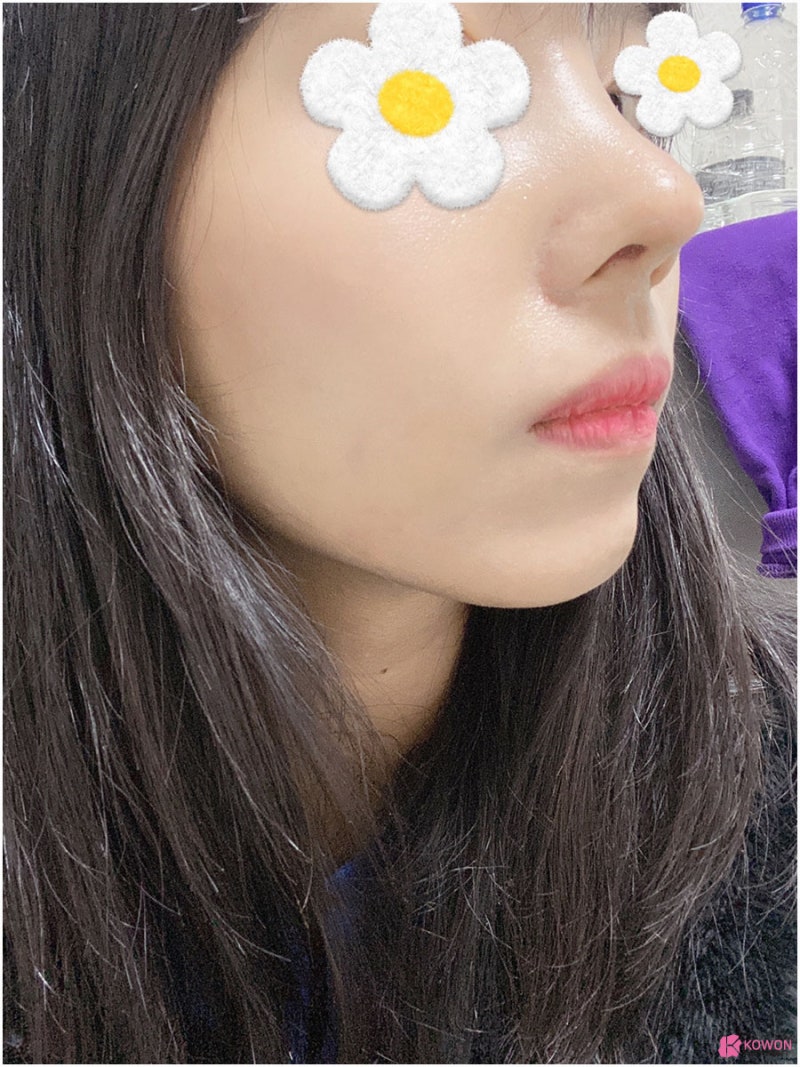 코끝처짐 라인 개선한 청담성형외과 사진 11