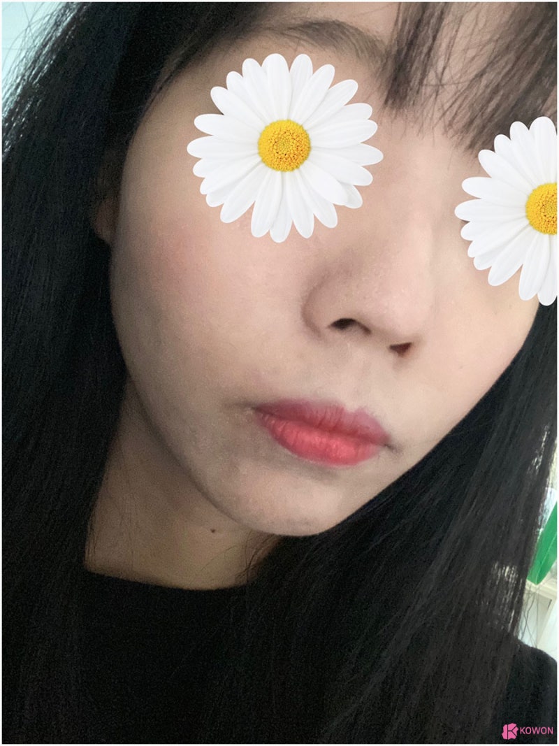 코끝처짐 라인 개선한 청담성형외과 사진 5