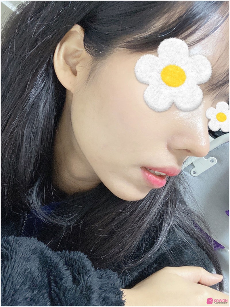 코끝처짐 라인 개선한 청담성형외과 사진 12