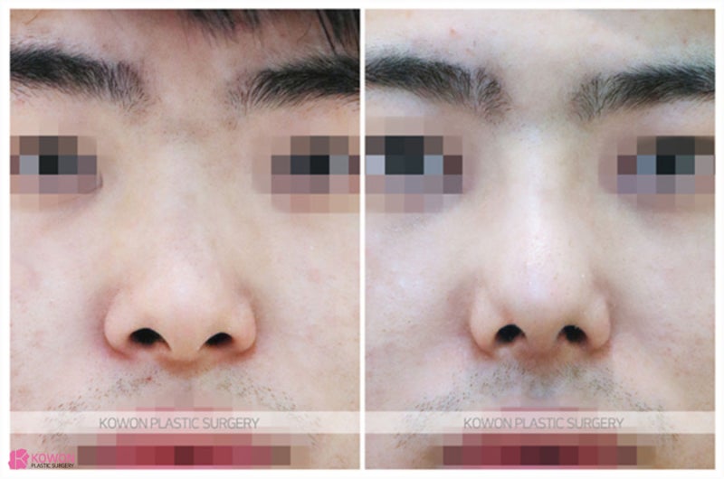 비중격만곡증교정 기능 문제 개선 비염코성형수술 사진 5