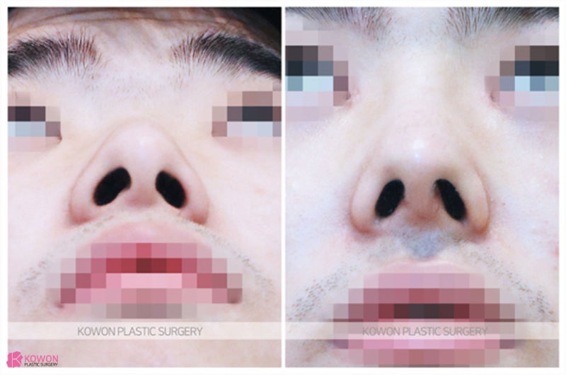 비중격만곡증교정 기능 문제 개선 비염코성형수술 사진 6