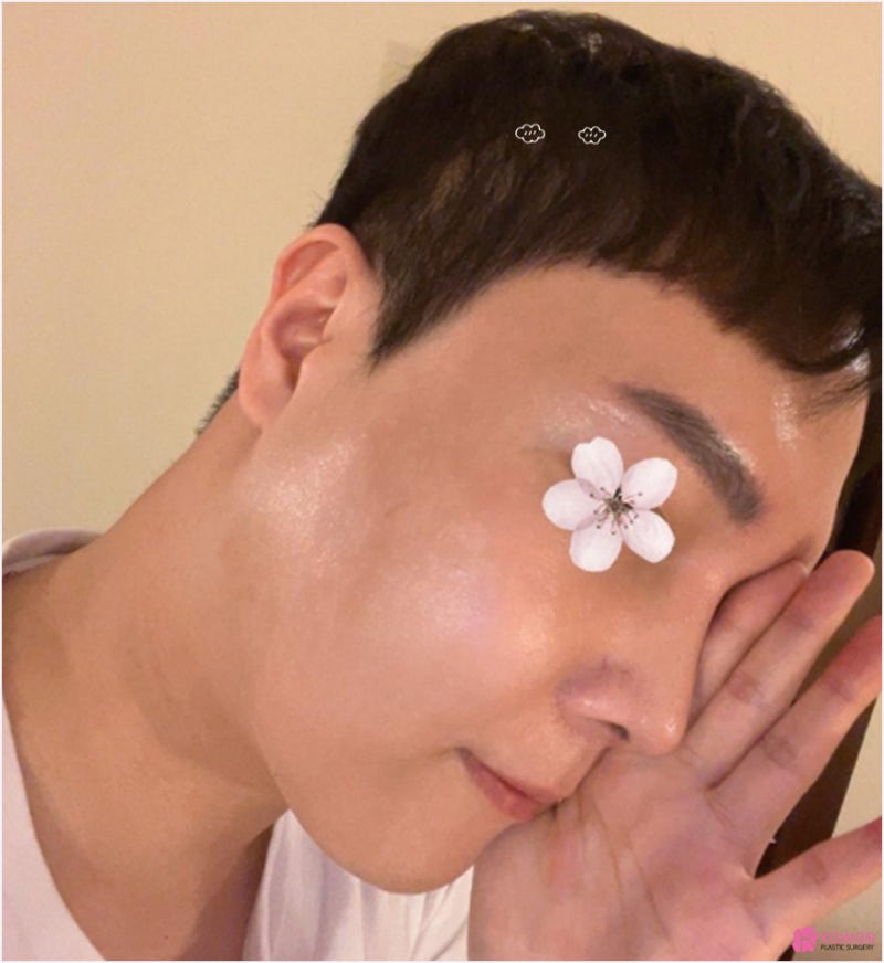 구축코 코재성형 원인 증상 부작용 형태 인상 사진 7