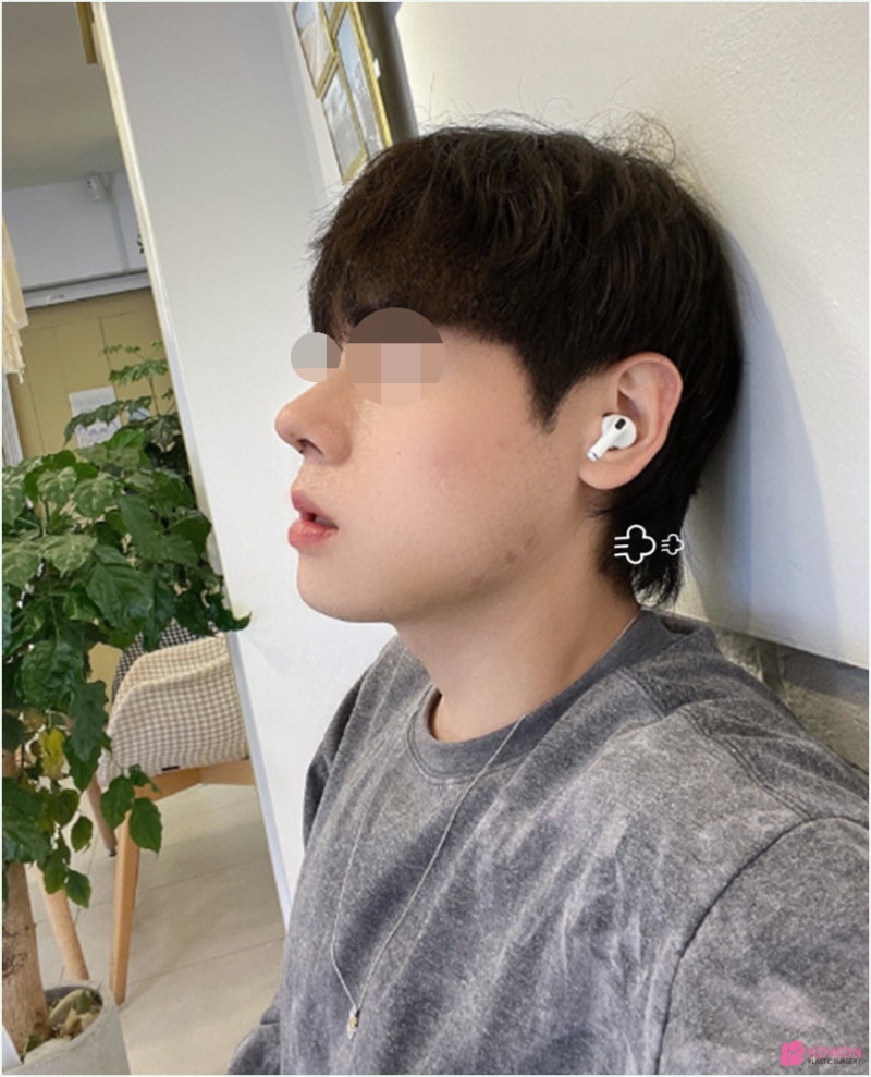 강남코성형 날렵한코 모양 라인 비교 진단 방법 사진 4