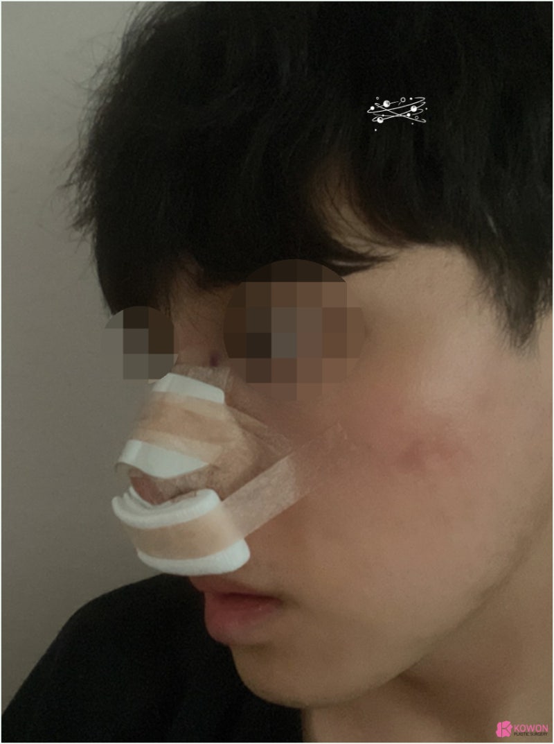 강남코성형 날렵한코 모양 라인 비교 진단 방법 사진 3