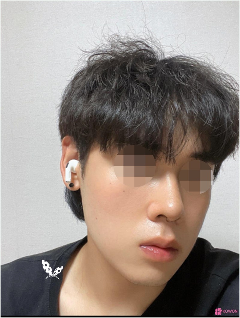 강남코성형 날렵한코 모양 라인 비교 진단 방법 사진 6