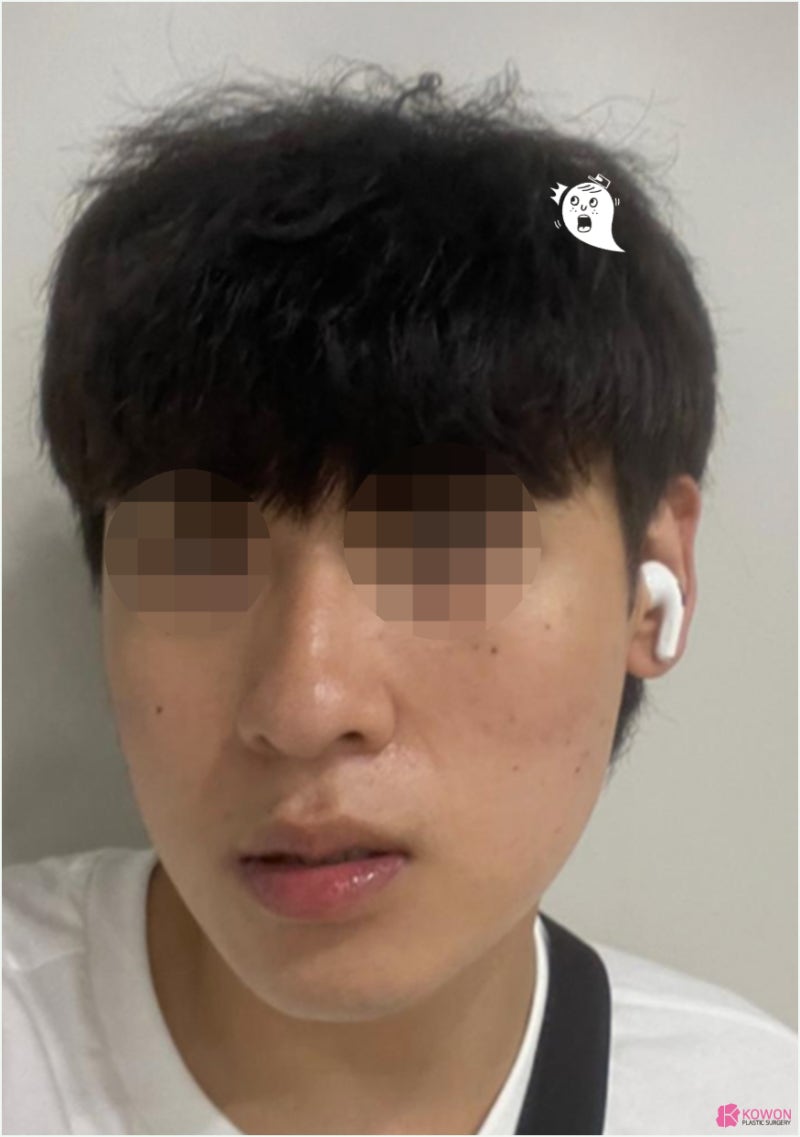 강남코성형 날렵한코 모양 라인 비교 진단 방법 사진 2