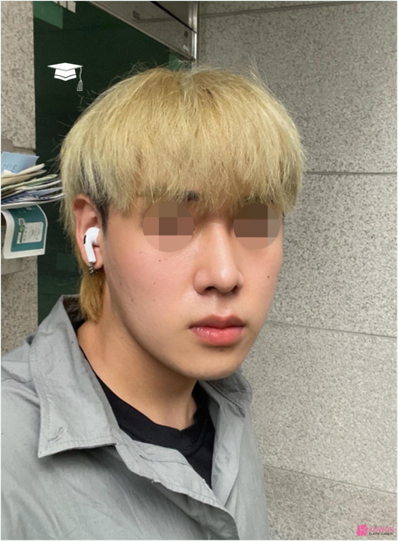 강남코성형 날렵한코 모양 라인 비교 진단 방법 사진 12