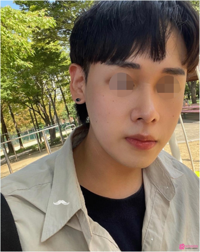 강남코성형 날렵한코 모양 라인 비교 진단 방법 사진 10