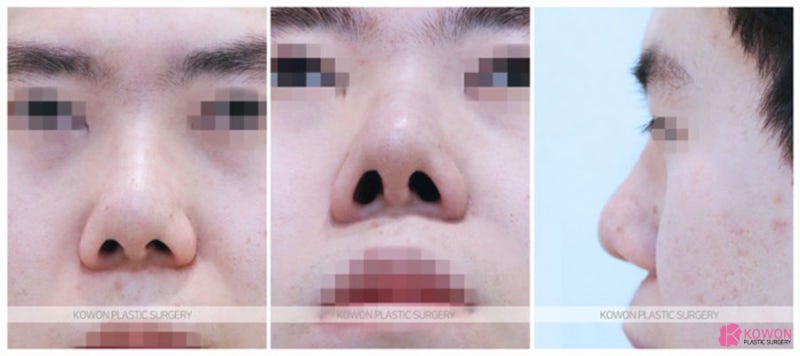 압구정동성형외과 뭉툭한 남자복코 개선 사례 사진 2