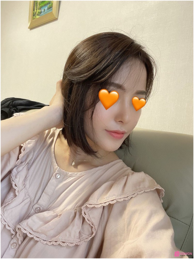 직반버선코 세련된 콧대 모양 논현동성형외과 사진 11